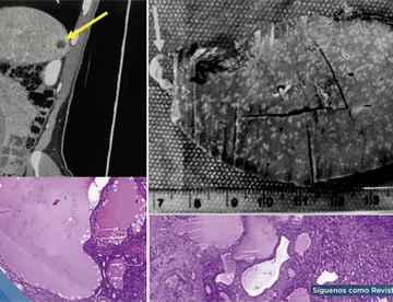 Linfangioma esplénico imitó recaída de cáncer de joven en seguimiento por linfoma tras lesiones en bazo