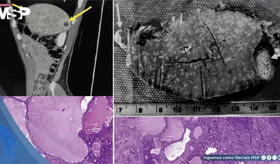 Linfangioma esplénico imitó recaída de cáncer de joven en seguimiento por linfoma tras lesiones en bazo