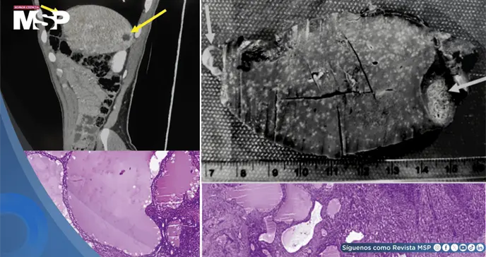 Linfangioma esplénico imitó recaída de cáncer de joven en seguimiento por linfoma tras lesiones en bazo Linfangioma esplénico imitó recaída de cáncer de joven en seguimiento por linfoma tras lesiones en bazo