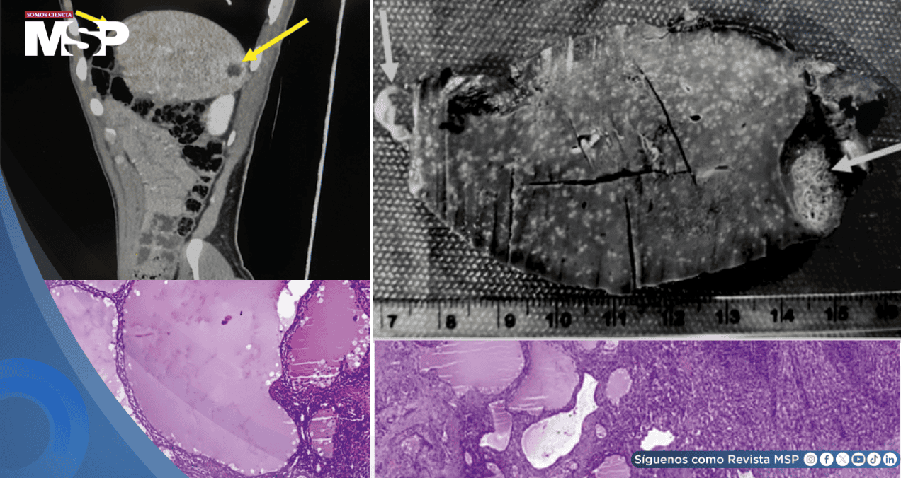 Linfangioma esplénico imitó recaída de cáncer de joven en seguimiento por linfoma tras lesiones en bazo Linfangioma esplénico imitó recaída de cáncer de joven en seguimiento por linfoma tras lesiones en bazo