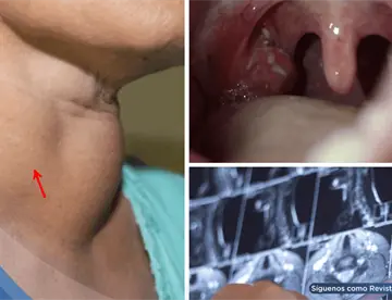 Consumo de vapeadores y alcohol multiplicaría hasta 20 veces el riesgo de cáncer de cabeza y cuello