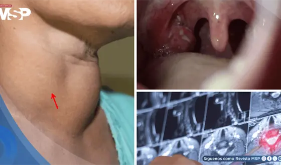 Consumo de vapeadores y alcohol multiplicaría hasta 20 veces el riesgo de cáncer de cabeza y cuello