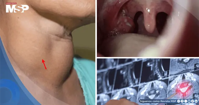 Consumo de vapeadores y alcohol multiplicaría hasta 20 veces el riesgo de cáncer de cabeza y cuello