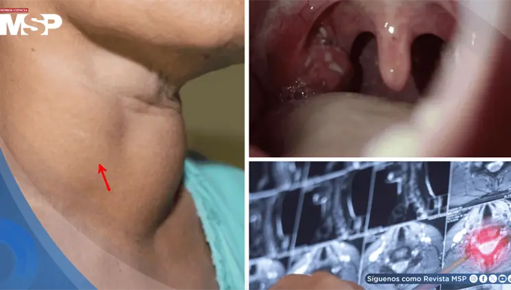 Consumo de vapeadores y alcohol multiplicaría hasta 20 veces el riesgo de cáncer de cabeza y cuello Consumo de vapeadores y alcohol multiplicaría hasta 20 veces el riesgo de cáncer de cabeza y cuello