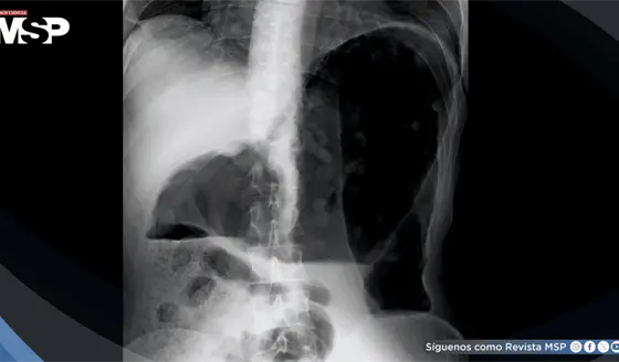 Megacolon tóxico asociado a clozapina: Distensión abdominal severa y delirio agudo en paciente de 29 años