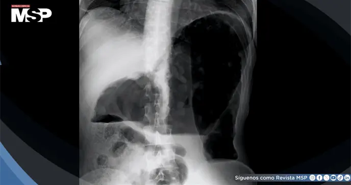 Megacolon tóxico asociado a clozapina: Distensión abdominal severa y delirio agudo en paciente de 29 años Megacolon tóxico asociado a clozapina: Distensión abdominal severa y delirio agudo en paciente de 29 años