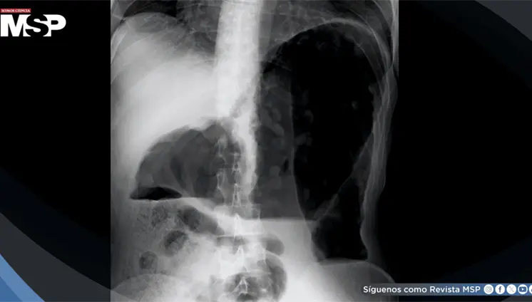 Megacolon tóxico asociado a clozapina: Distensión abdominal severa y delirio agudo en paciente de 29 años Megacolon tóxico asociado a clozapina: Distensión abdominal severa y delirio agudo en paciente de 29 años