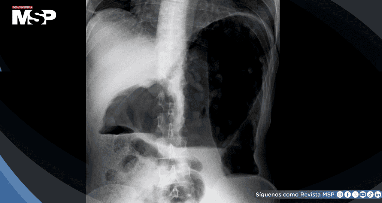 Megacolon tóxico asociado a clozapina: Distensión abdominal severa y delirio agudo en paciente de 29 años