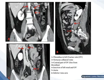 Trombosis venosa ovárica izquierda en mujer con dolor abdominal progresivo y masa cordonal palpable 