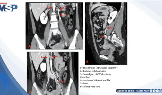 Trombosis venosa ovárica izquierda en mujer con dolor abdominal progresivo y masa cordonal palpable 