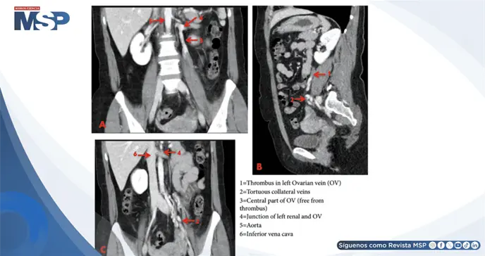 Trombosis venosa ovárica izquierda en mujer con dolor abdominal progresivo y masa cordonal palpable Trombosis venosa ovárica izquierda en mujer con dolor abdominal progresivo y masa cordonal palpable
