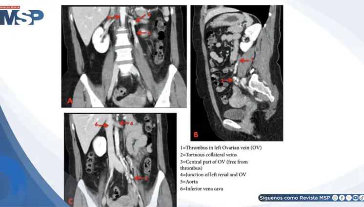Trombosis venosa ovárica izquierda en mujer con dolor abdominal progresivo y masa cordonal palpable Trombosis venosa ovárica izquierda en mujer con dolor abdominal progresivo y masa cordonal palpable