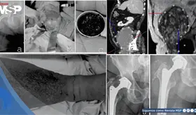 Masa de más de 15 cm secundaria a desgaste de prótesis metal-metal implantada 27 años atrás simuló cáncer