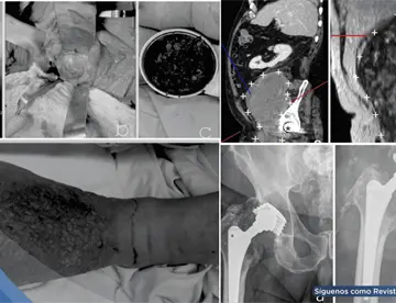 Masa de más de 15 cm secundaria a desgaste de prótesis metal-metal implantada 27 años atrás simuló cáncer