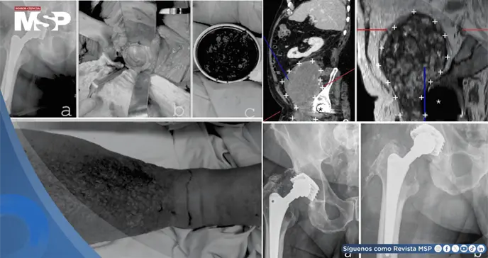 Masa de más de 15 cm secundaria a desgaste de prótesis metal-metal implantada 27 años atrás simuló cáncer