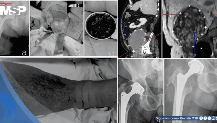 Masa de más de 15 cm secundaria a desgaste de prótesis metal-metal implantada 27 años atrás simuló cáncer Masa de más de 15 cm secundaria a desgaste de prótesis metal-metal implantada 27 años atrás simuló cáncer