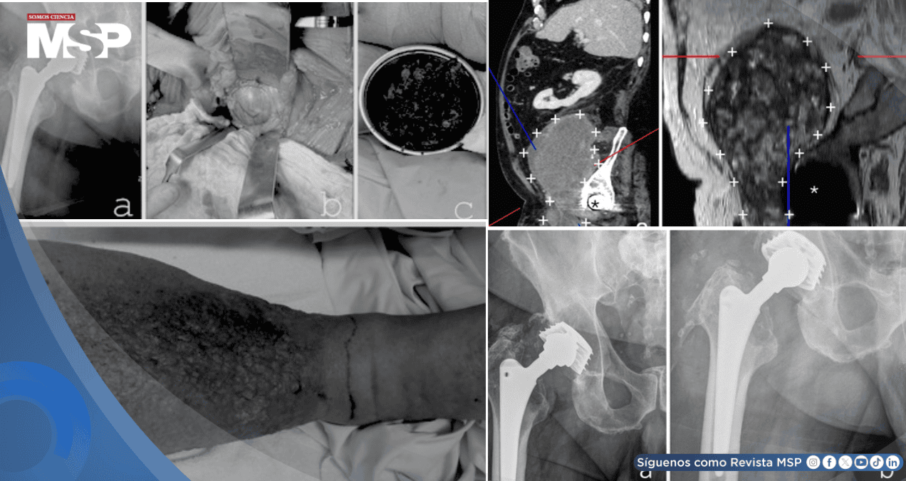 Masa de más de 15 cm secundaria a desgaste de prótesis metal-metal implantada 27 años atrás simuló cáncer Masa de más de 15 cm secundaria a desgaste de prótesis metal-metal implantada 27 años atrás simuló cáncer