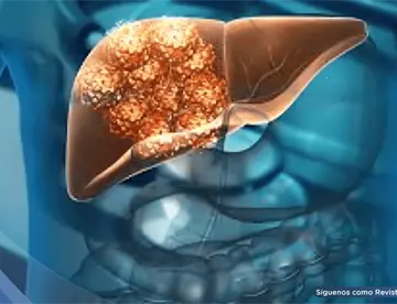 Análisis de sangre predice riesgo de cirrosis o cáncer de hígado hasta 10 años antes con 88% de precisión