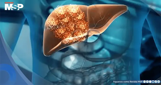 Análisis de sangre predice riesgo de cirrosis o cáncer de hígado hasta 10 años antes con 88% de precisión