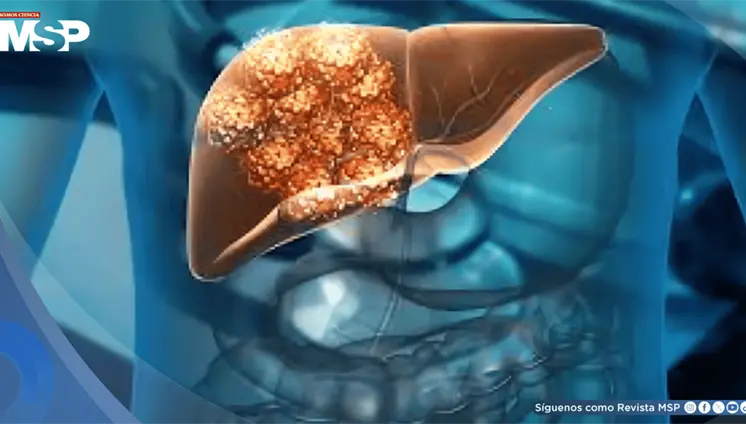 Análisis de sangre predice riesgo de cirrosis o cáncer de hígado hasta 10 años antes con 88% de precisión