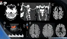 Infarto isquémico agudo provoca episodios transitorios de inclinación visual y vértigo en paciente
