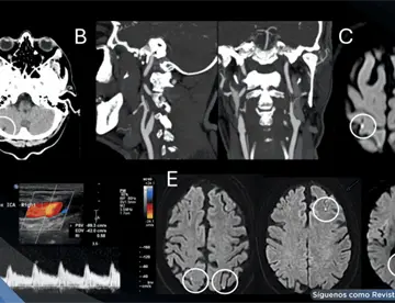 Infarto isquémico agudo provoca episodios transitorios de inclinación visual y vértigo en paciente