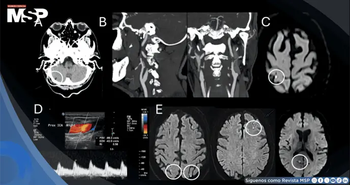 Infarto isquémico agudo provoca episodios transitorios de inclinación visual y vértigo en paciente