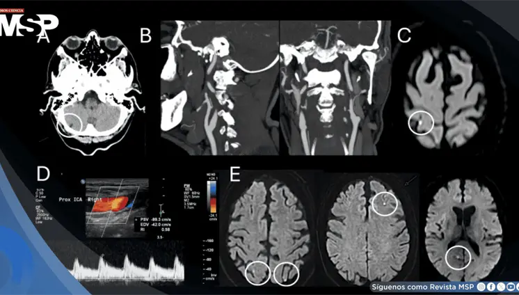 Infarto isquémico agudo provoca episodios transitorios de inclinación visual y vértigo en paciente