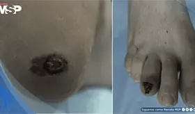 Melanoma maligno plantar confundido con úlcera diabética en pacientes con diabetes mellitus tipo 2