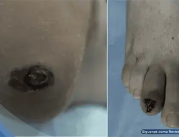 Melanoma maligno plantar confundido con úlcera diabética en pacientes con diabetes mellitus tipo 2