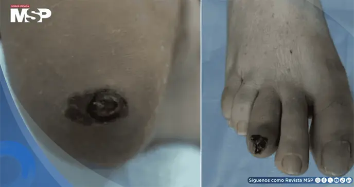 Melanoma maligno plantar confundido con úlcera diabética en pacientes con diabetes mellitus tipo 2 Melanoma maligno plantar confundido con úlcera diabética en pacientes con diabetes mellitus tipo 2