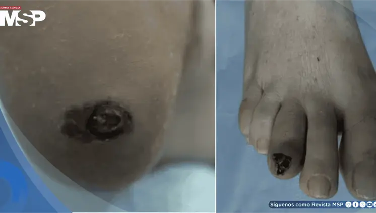 Melanoma maligno plantar confundido con úlcera diabética en pacientes con diabetes mellitus tipo 2 Melanoma maligno plantar confundido con úlcera diabética en pacientes con diabetes mellitus tipo 2
