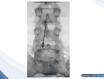 Parche hemático epidural resolvió cefalea postpunción dural en paciente con leucemia