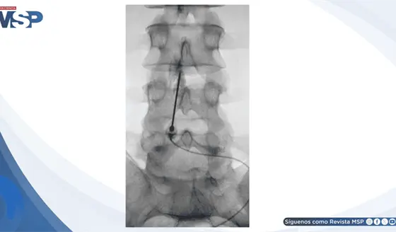Parche hemático epidural resolvió cefalea postpunción dural en paciente con leucemia