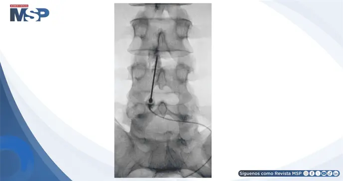Parche hemático epidural resolvió cefalea postpunción dural en paciente con leucemia Parche hemático epidural resolvió cefalea postpunción dural en paciente con leucemia