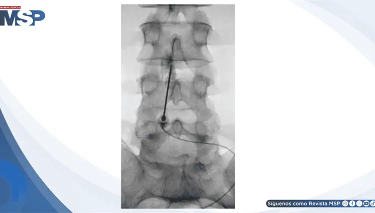 Parche hemático epidural resolvió cefalea postpunción dural en paciente con leucemia Parche hemático epidural resolvió cefalea postpunción dural en paciente con leucemia