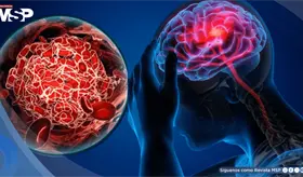 Los cinco síntomas más comunes de un ACV y por qué no debes esperar para ir al hospital, según neurólogo