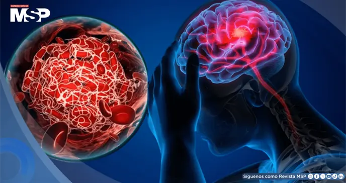 Los cinco síntomas más comunes de un ACV y por qué no debes esperar para ir al hospital, según neurólogo Los cinco síntomas más comunes de un ACV y por qué no debes esperar para ir al hospital, según neurólogo