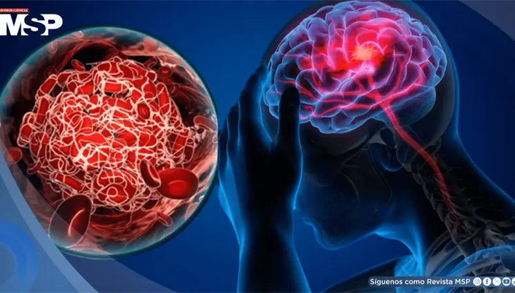 Los cinco síntomas más comunes de un ACV y por qué no debes esperar para ir al hospital, según neurólogo Los cinco síntomas más comunes de un ACV y por qué no debes esperar para ir al hospital, según neurólogo