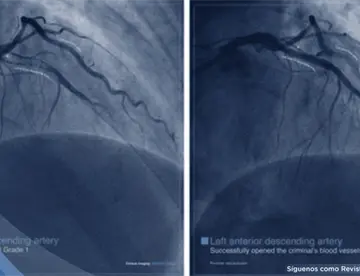 ¿Qué es un infarto agudo de miocardio? no siempre empieza con dolor en el pecho: Síntomas y manejo