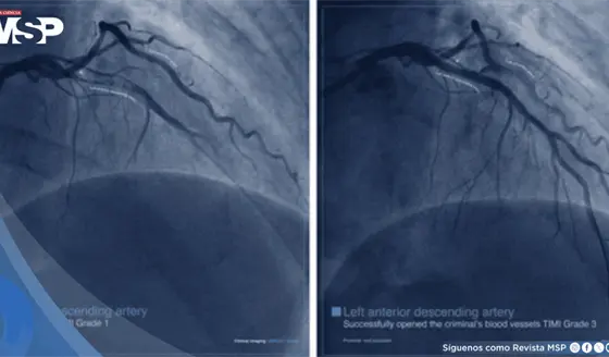 ¿Qué es un infarto agudo de miocardio? no siempre empieza con dolor en el pecho: Síntomas y manejo