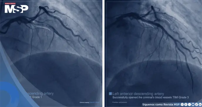 ¿Qué es un infarto agudo de miocardio? no siempre empieza con dolor en el pecho: Síntomas y manejo ¿Qué es un infarto agudo de miocardio? no siempre empieza con dolor en el pecho: Síntomas y manejo