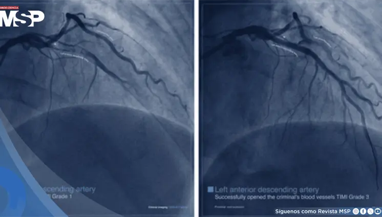 ¿Qué es un infarto agudo de miocardio? no siempre empieza con dolor en el pecho: Síntomas y manejo ¿Qué es un infarto agudo de miocardio? no siempre empieza con dolor en el pecho: Síntomas y manejo