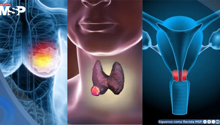 Las razones detrás del aumento del cáncer en mujeres menores de 50 años: Expertos Las razones detrás del aumento del cáncer en mujeres menores de 50 años: Expertos