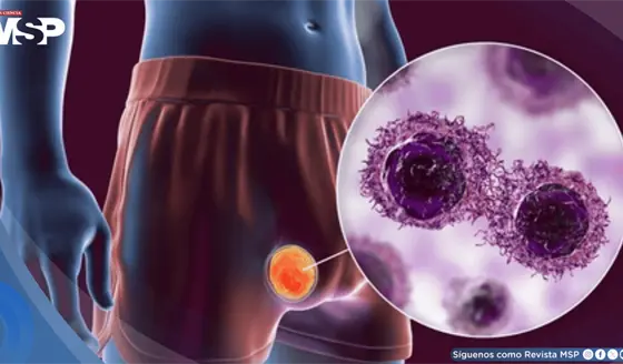C&aacute;ncer testicular con curaci&oacute;n supera el 95%, con riesgo de segundos c&aacute;nceres a largo plazo