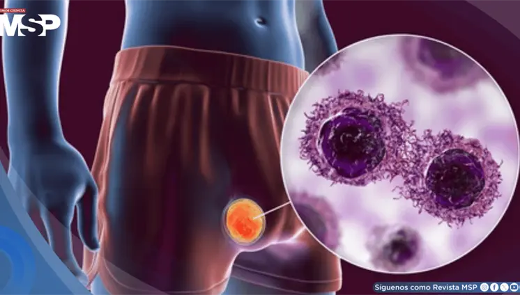 Cáncer testicular con curación supera el 95%, con riesgo de segundos cánceres a largo plazo Cáncer testicular con curación supera el 95%, con riesgo de segundos cánceres a largo plazo