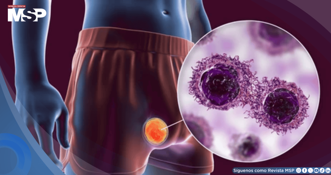 Cáncer testicular con curación supera el 95%, con riesgo de segundos cánceres a largo plazo Cáncer testicular con curación supera el 95%, con riesgo de segundos cánceres a largo plazo