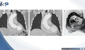 Dolor torácico pleurítico como presentación de hematoma intramural y disección de aorta ascendente