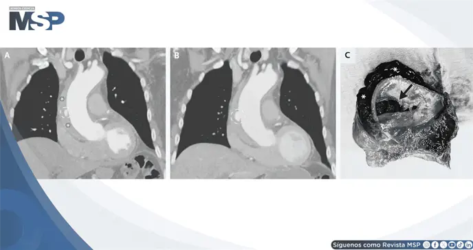 Dolor tor&aacute;cico pleur&iacute;tico como presentaci&oacute;n de hematoma intramural y disecci&oacute;n de aorta ascendente