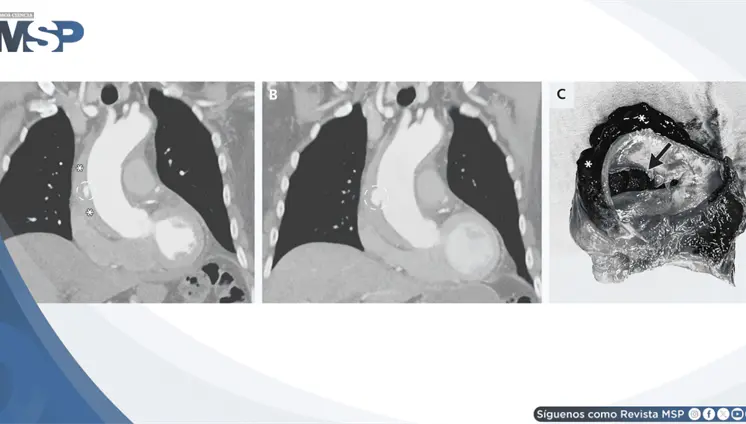 Dolor torácico pleurítico como presentación de hematoma intramural y disección de aorta ascendente Dolor torácico pleurítico como presentación de hematoma intramural y disección de aorta ascendente